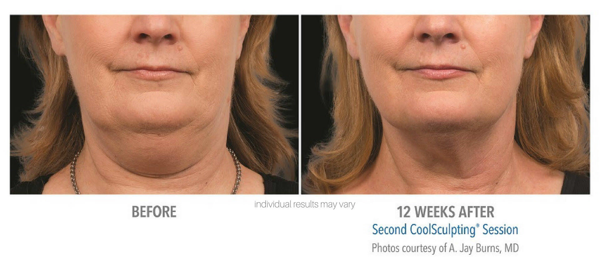 coolsculpting-before-and-after-photos_2