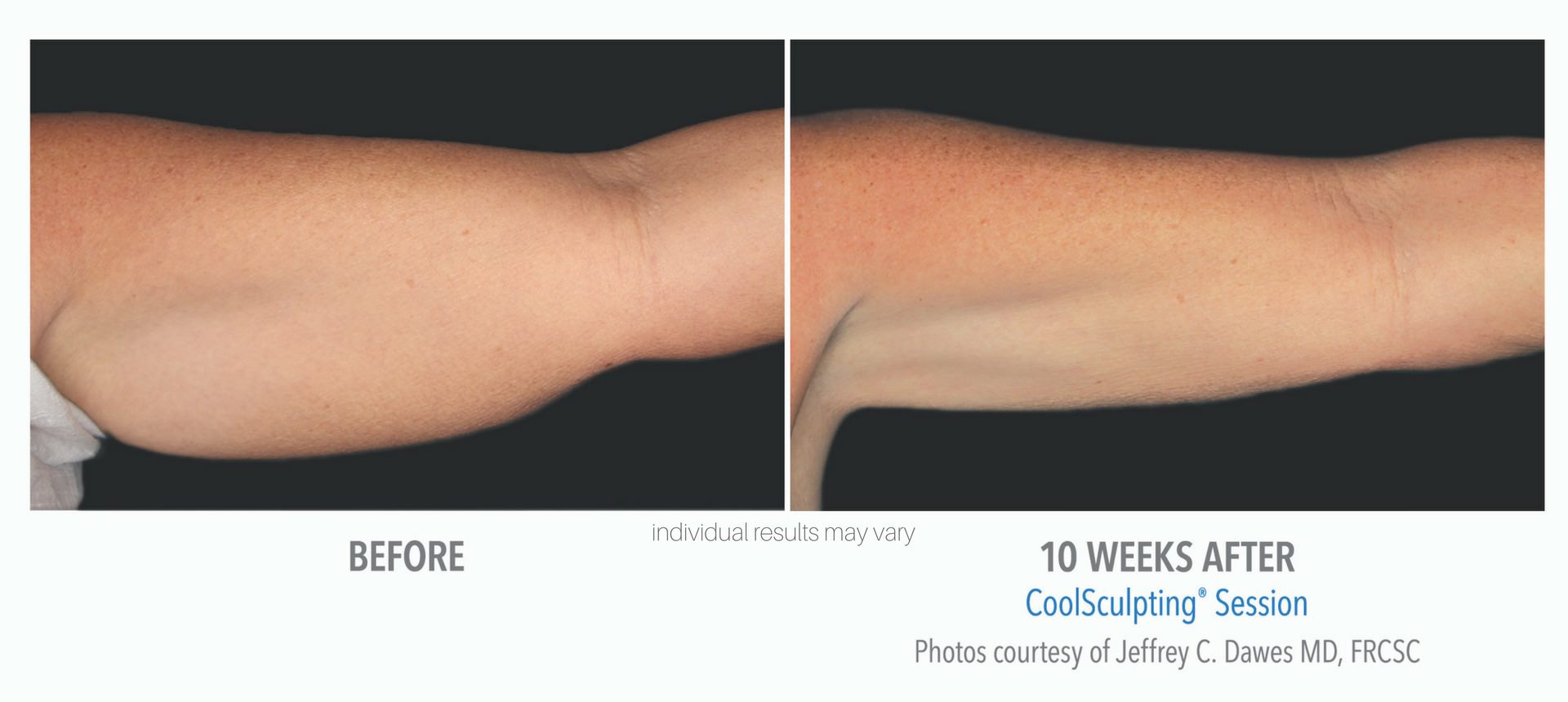 coolsculpting-before-and-after-photos_3