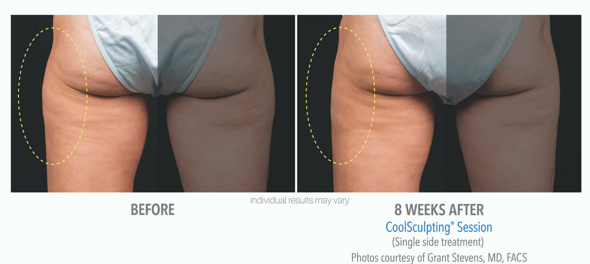 coolsculpting-before-and-after-photos_4