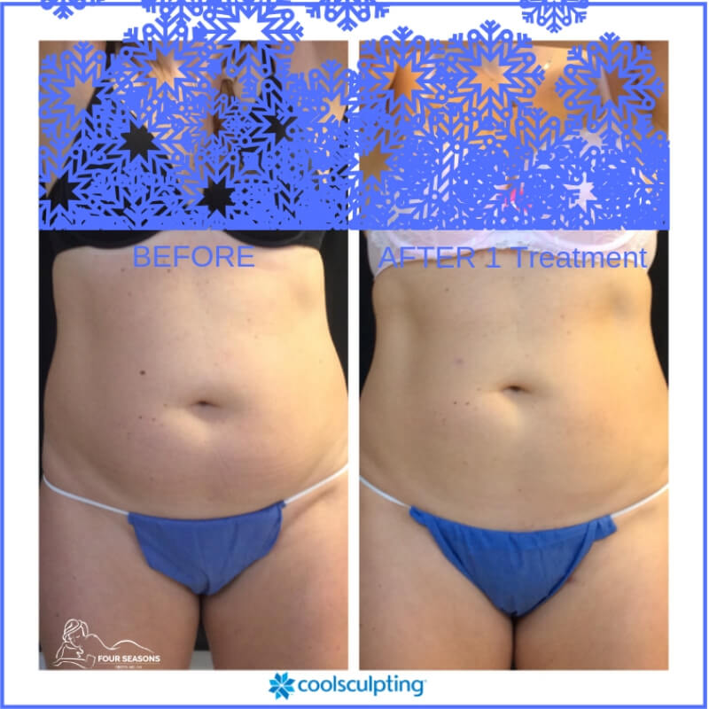 coolsculpting-fourseasons-before-after-photos-10
