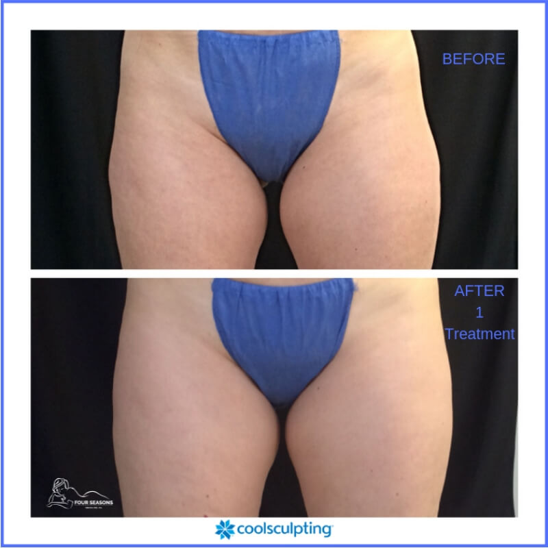 coolsculpting-fourseasons-before-after-photos-12