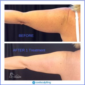 coolsculpting before and after