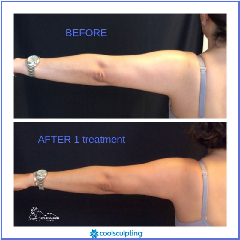 coolsculpting-fourseasons-before-after-photos-6