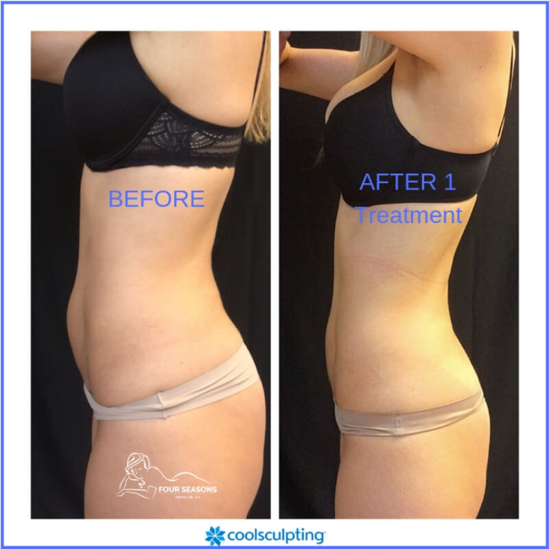 coolsculpting before and after