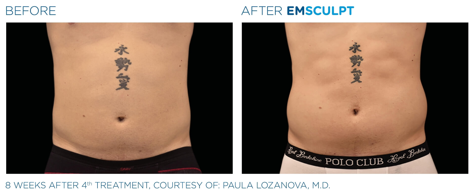 four-seasons-obgyn-emsculpt-before-and-after-1