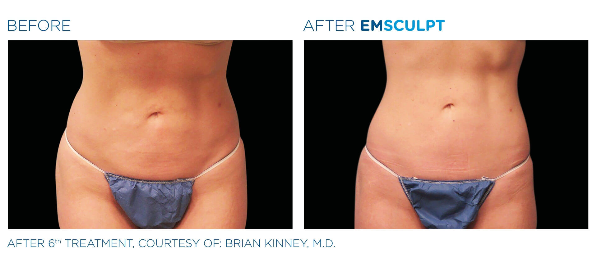 four-seasons-obgyn-emsculpt-before-and-after-2