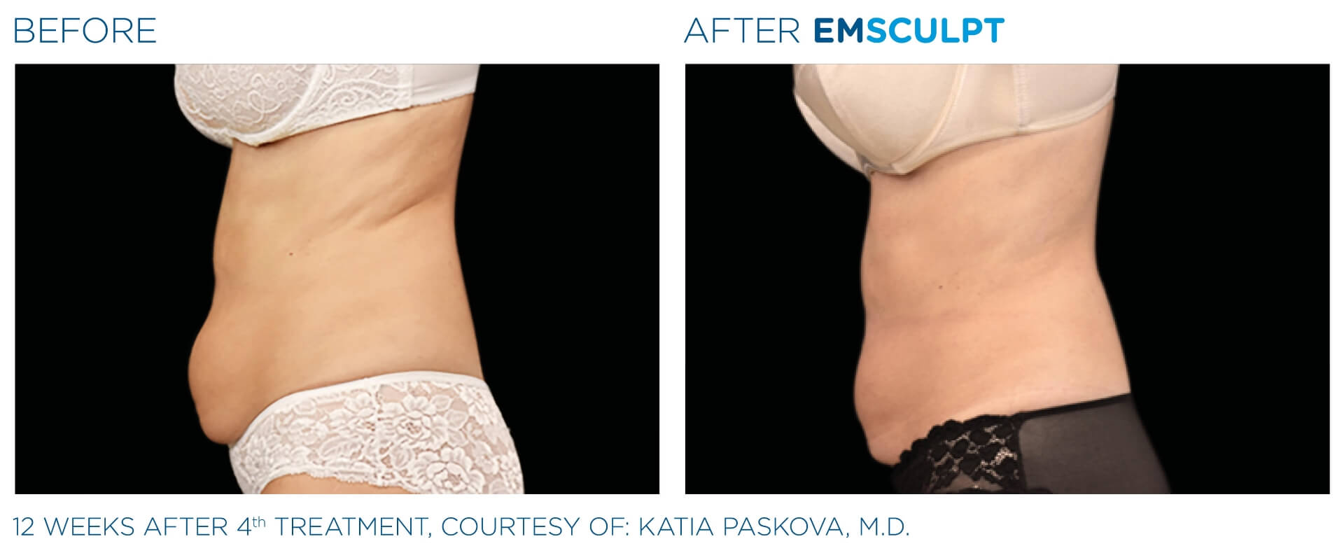 four-seasons-obgyn-emsculpt-before-and-after-3