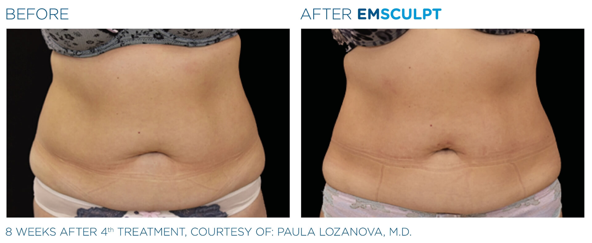 four-seasons-obgyn-emsculpt-before-and-after-4