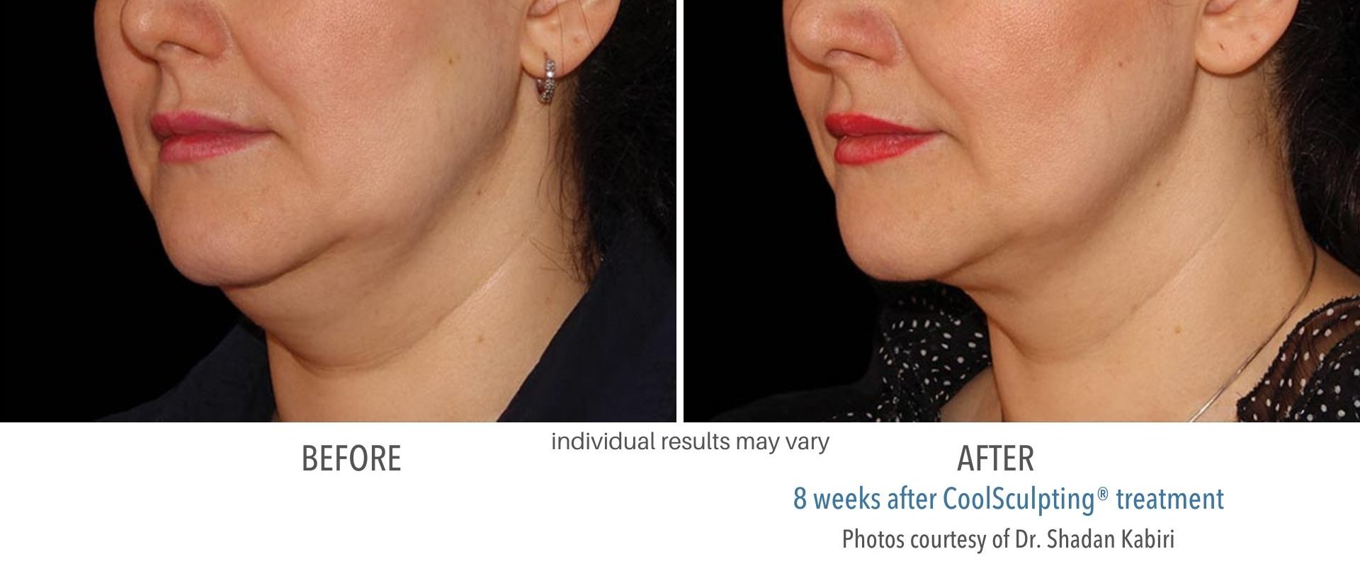 coolsculpting before and after San Antonio