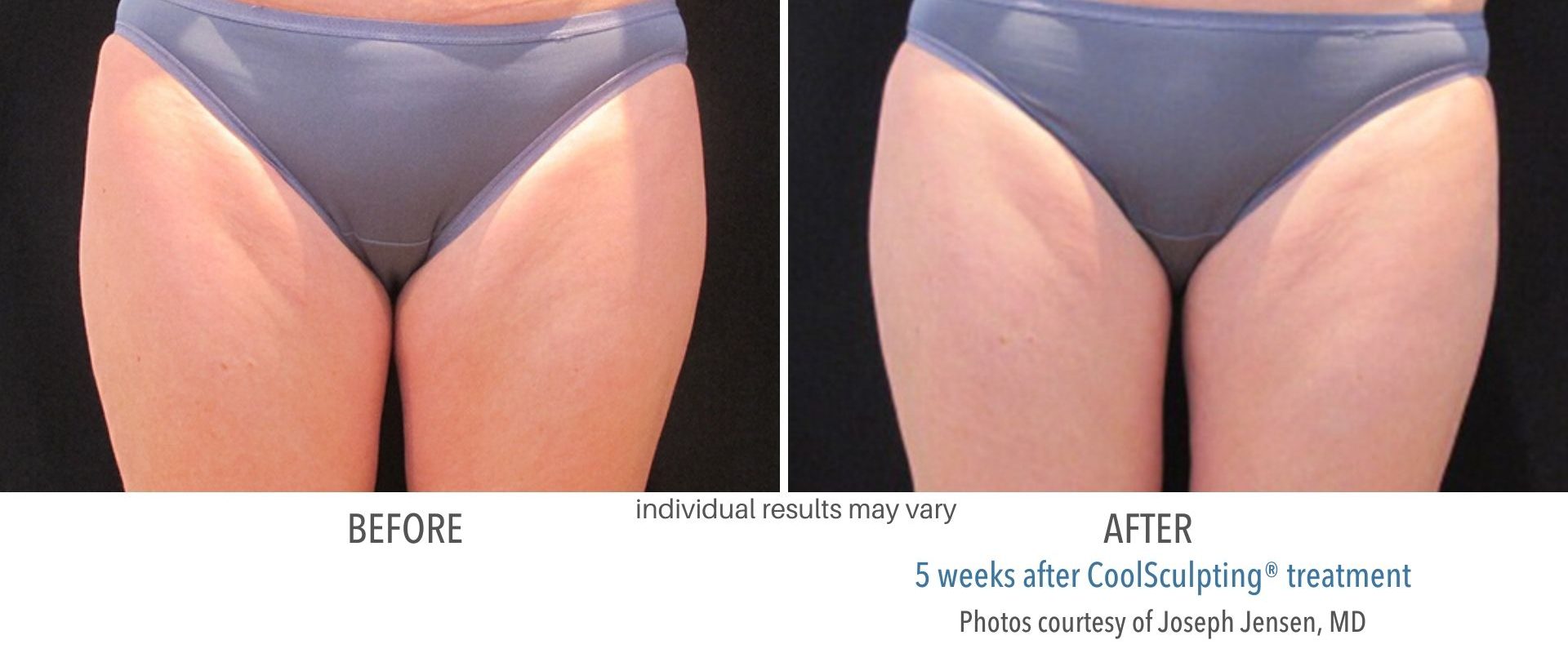 an image of coolsculpting before and after Four Seasons OBGYN