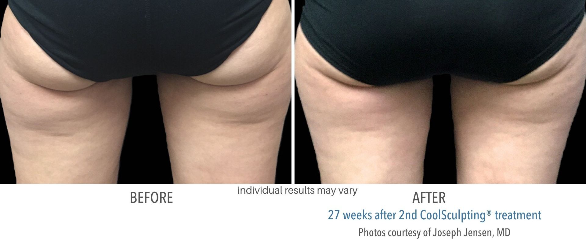 coolsculpting before and after San Antonio Four Seasons OBGYN