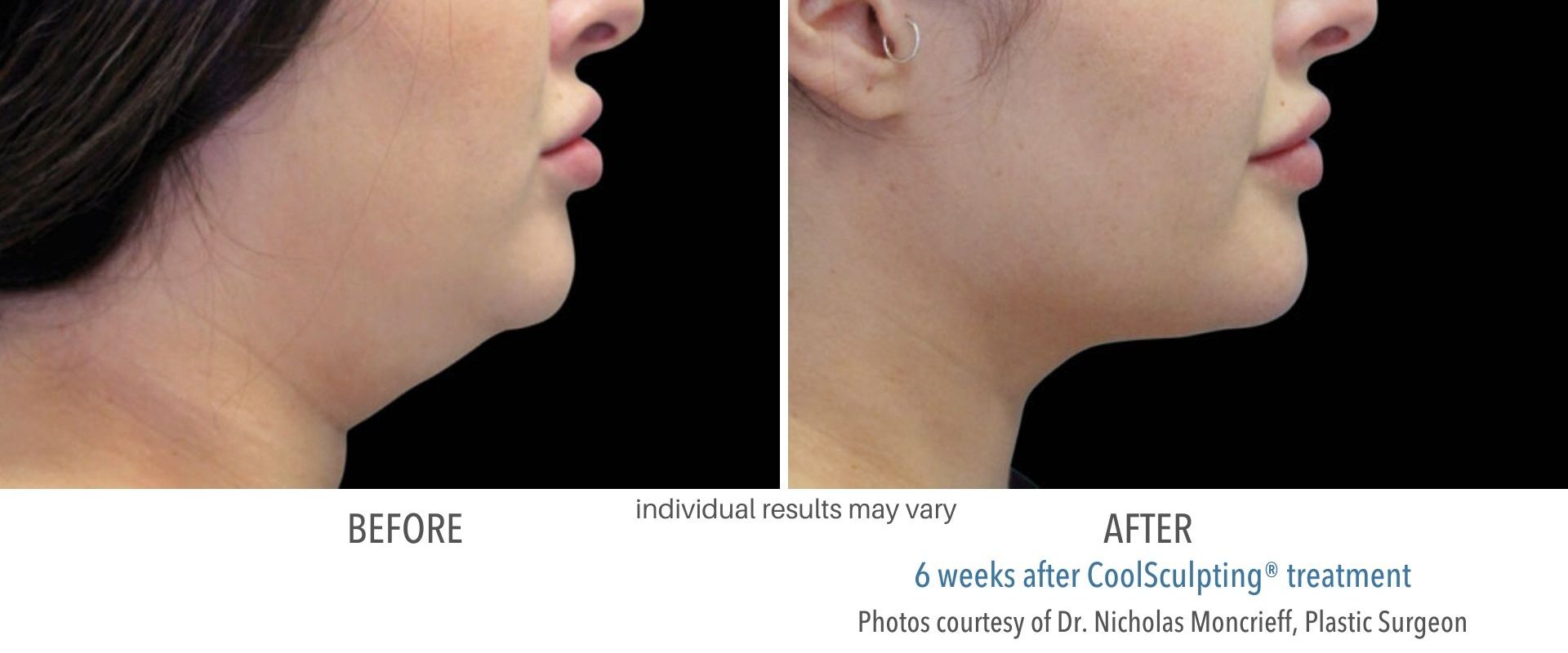 coolsculpting before and after double chin