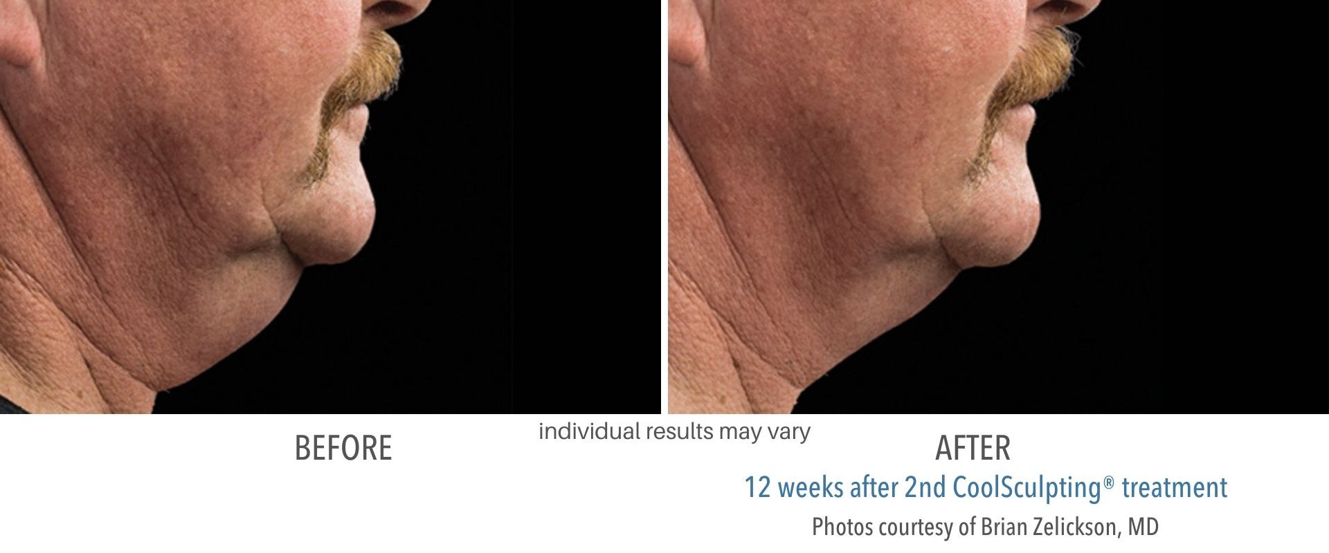 coolsculpting before & after San Antonio double chin