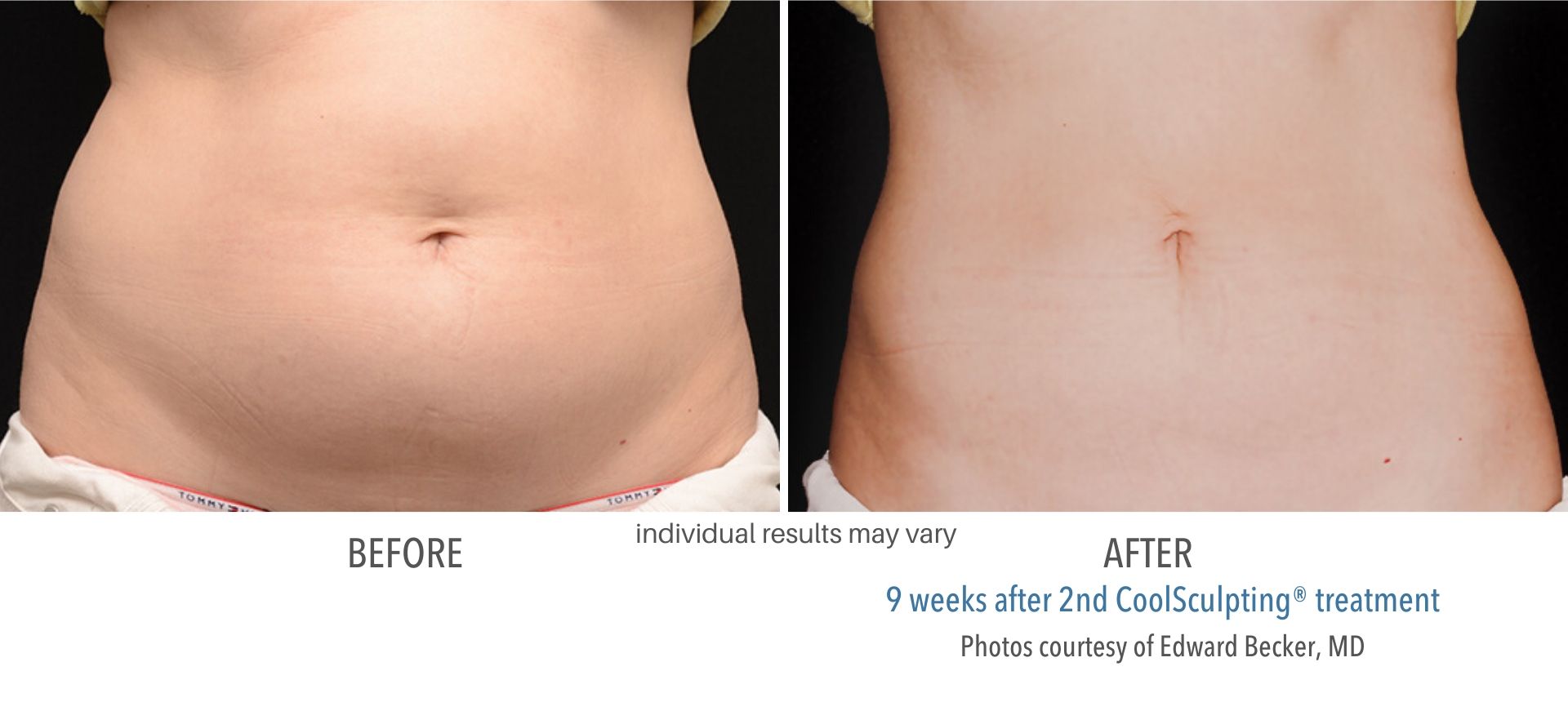CoolSculpting Before and After Images | Real Patients + Real Results