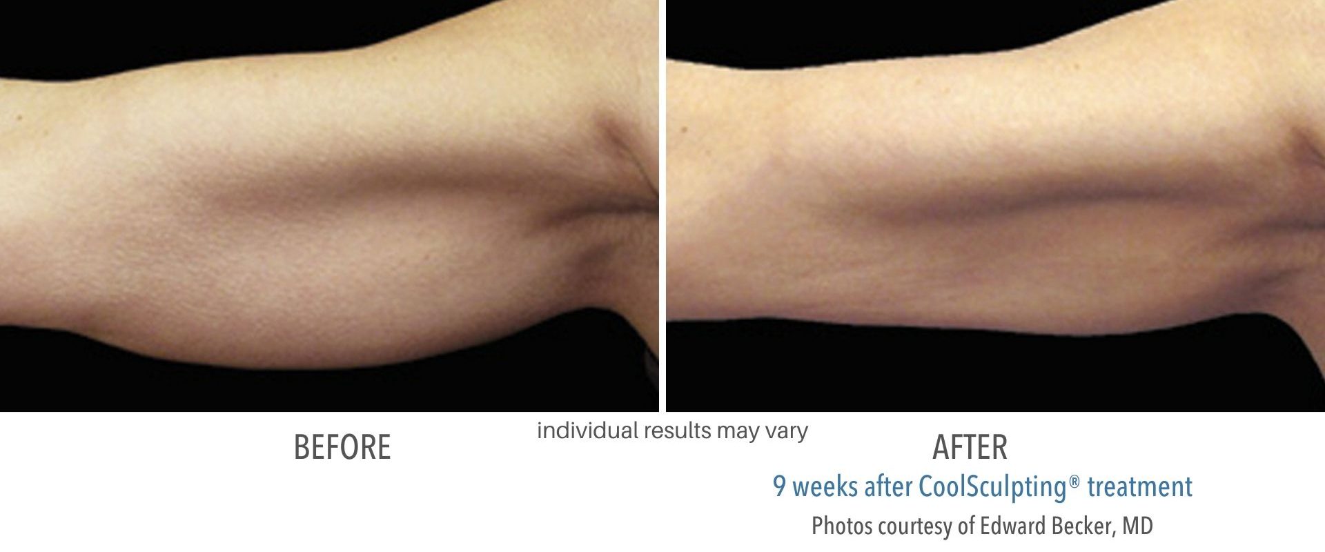 coolsculpting before and after arms