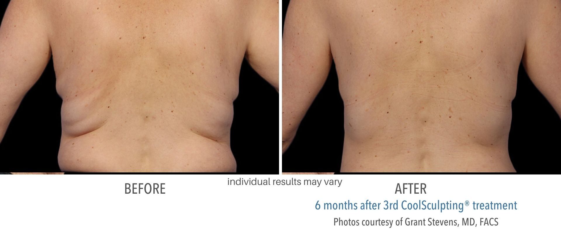 coolsculpting before and after Four Seasons
