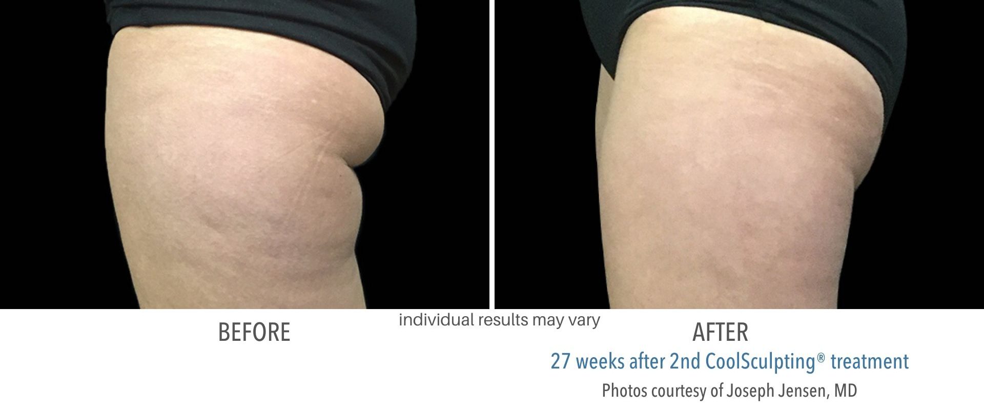 an image of coolsculpting before and after in San Antonio